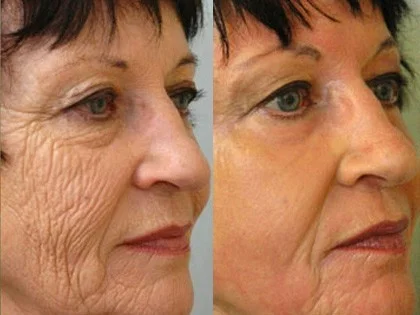 Before and after using Gelagen