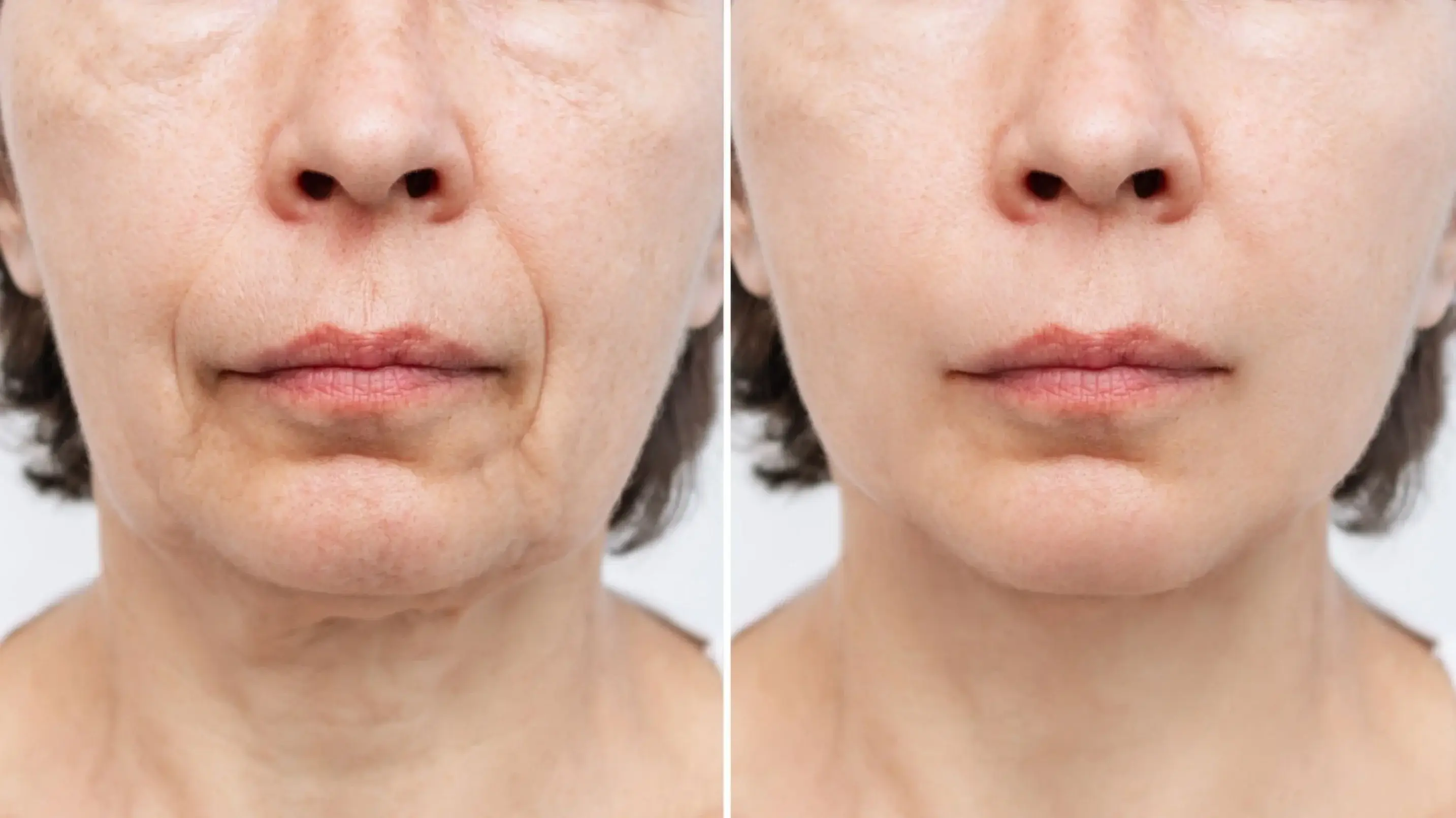 Before and after using Gelagen